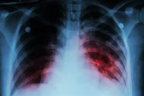 INFORMES SOBRE TUBERCULOSIS EN LAS ESCUELAS